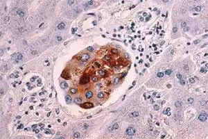 pancreatic cancer