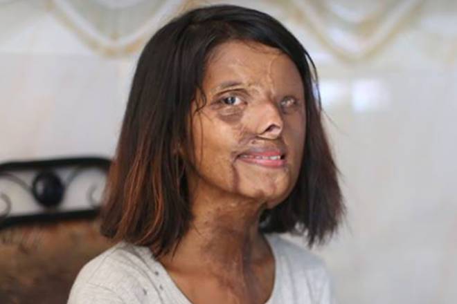 acid attack, mumbai girl shaboo, shabbo, humans of bombay, viral stories, trending stories