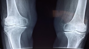 AbbVie, Rinvoq, rheumatoid arthritis, active psoriatic arthritis, spondylitis, dermatitis, health news,