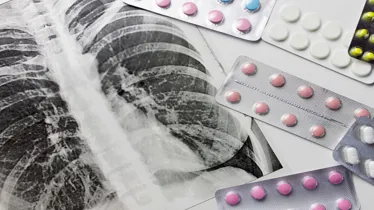 Tuberculosis, Tuberculosis in India, TB burden in India, healthcare news,