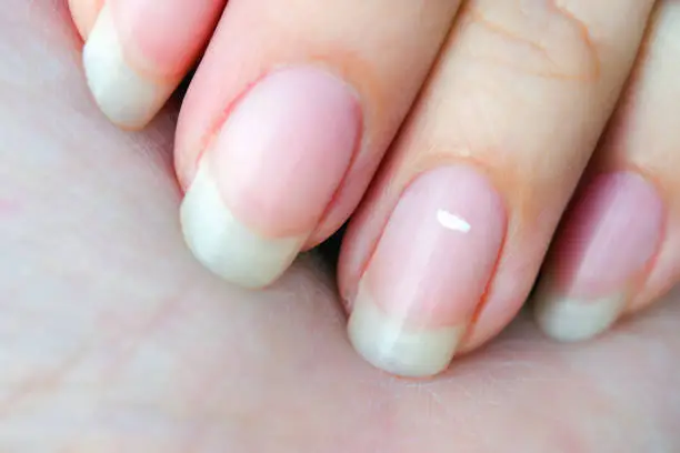 Why do white spots appear on nails? - Entrenosotros | Consum