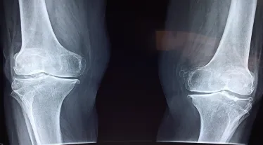 orthopedics, 3d revolution, healthcare news, medical devices,