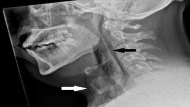Sneeze, sneeze incident, bizarre medical case, healthcare news,