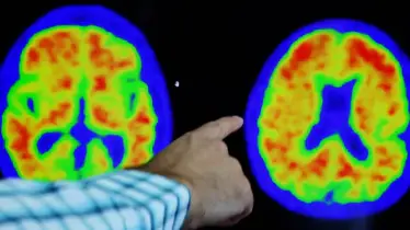 Alzheimer, Neurological disorder