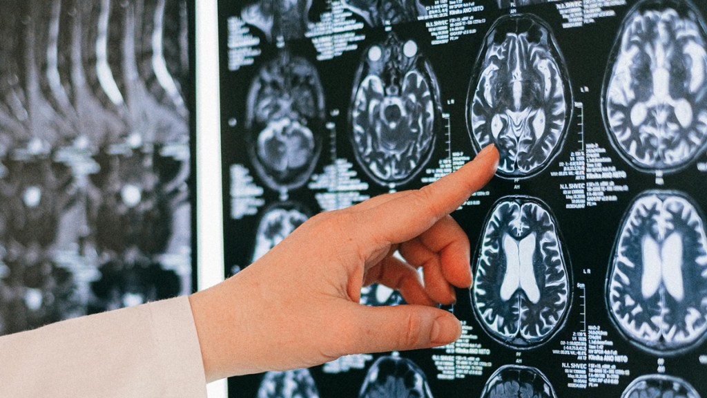 World Stroke Day 2024 Warning signs of stroke that you must know