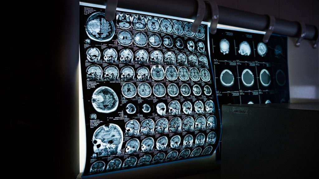 HMPV, HMPV affects brain, HMPV Effects on Brain, Immune-Mediated Encephalitis, hMPV Linked Encephalitis Treatment, health news, HMPV in India,
