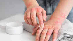 32-year-old woman struggled with itchy skin and nail damage for 5 months — Doctors finally found the real cause