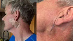 ‘Please don’t ignore sunscreen!’ Celebrity chef Gordon Ramsay undergoes skin cancer surgery, warns fans